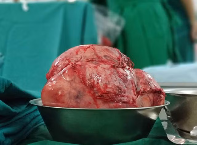 Trọng lượng của khối u lên tới 2,5kg