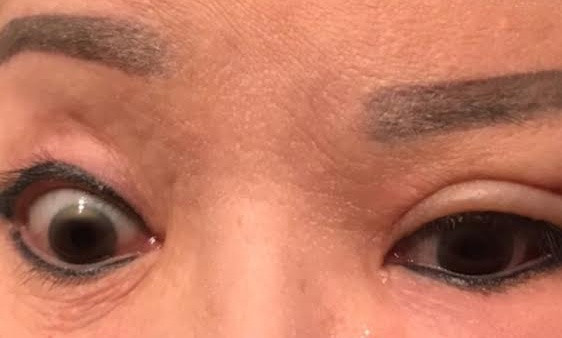 Cơ mặt bên trái của bệnh nhân bị liệt nên mắt không thể nhắm được. Cơ mặt bên trái của bà bị liệt, mắt không thể nhắm được. Ảnh: NVCC.