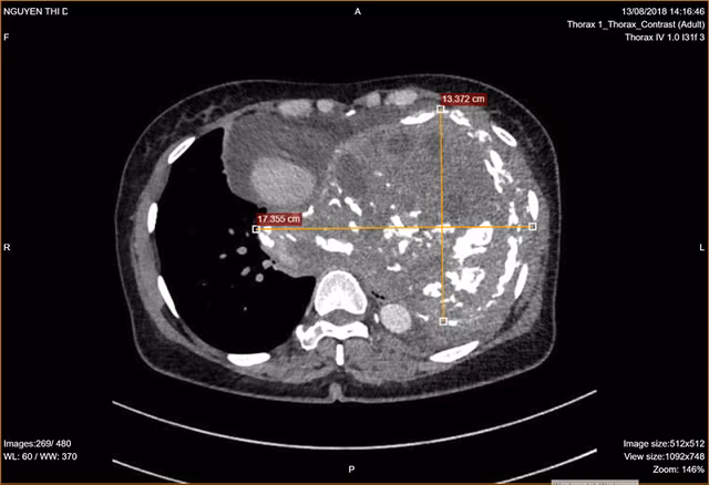Khối u lớn chiếm trọn lồng ngực trái của người bệnh 