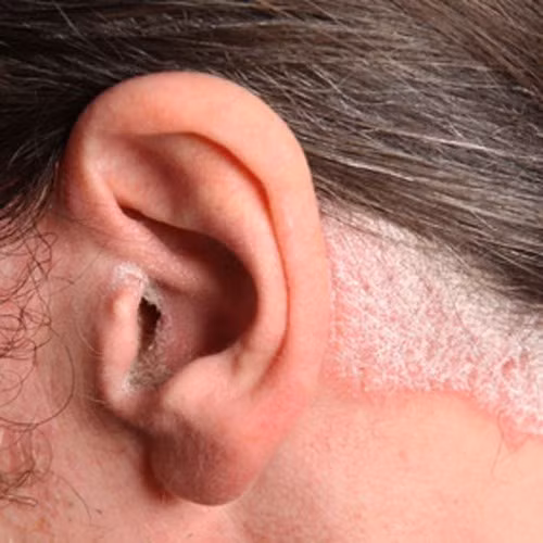 Người mắc vảy nến thường có những triệu chứng như vùng da bệnh ngứa, khô cứng, vảy đỏ hoặc vảy trắng phủ lên như sáp nến, vảy xếp chồng lên nhau, đùn ra thành từng lớp, bong tróc.