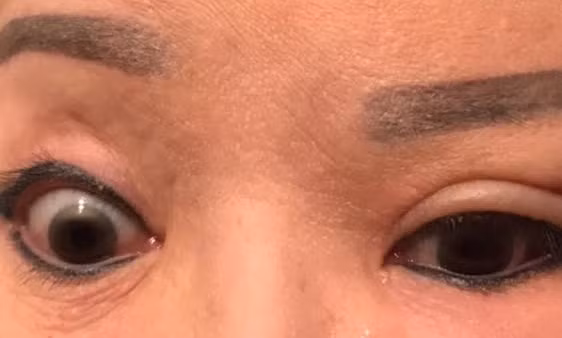 Người phụ nữ không thể nhắm mắt do biến chứng sau cắt mí