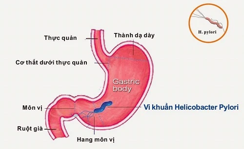 Dấu hiệu viêm dạ dày ở trẻ