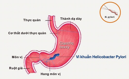 Dấu hiệu viêm dạ dày ở trẻ