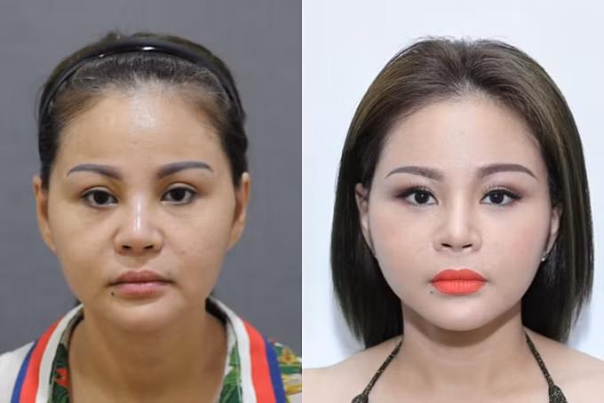 Sau 20 lần phẫu thuật thẩm mỹ, gương mặt diễn viên Lê Giang biến đổi ra sao? ảnh 3 Năm 2017, Lê Giang