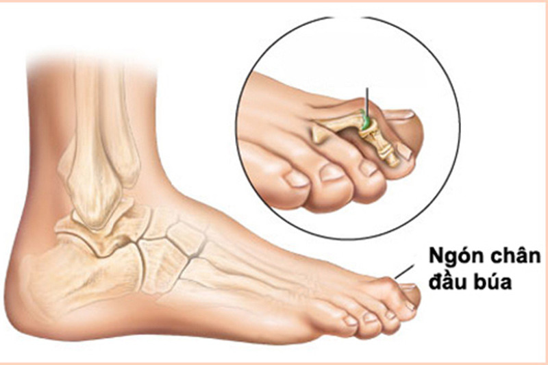 Lý do bệnh nhân tiểu đường hay bị gãy xương ảnh 2 Lý do bệnh nhân tiểu đường hay bị gãy xương ảnh 2