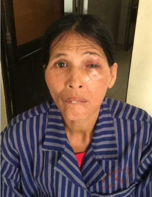 Mắt trái của bệnh nhân may mắn giữ được thị lực. Ảnh: Bệnh viện cung cấp.