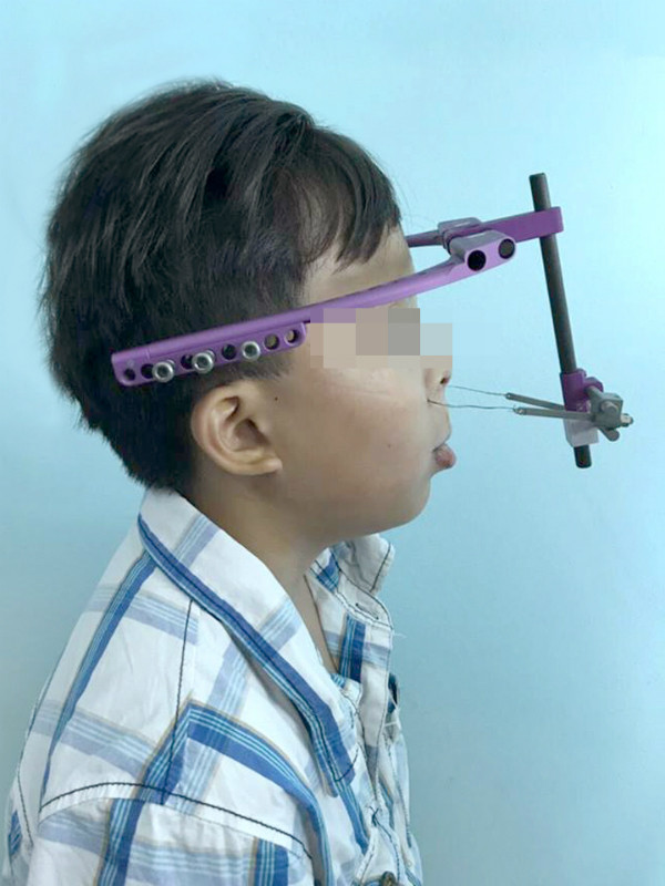 Dũng là bệnh nhi đầu tiên tại Việt Nam sử dụng khí cụ kéo dãn xương hàm để chỉnh hình khuôn mặt. Ảnh: N.P