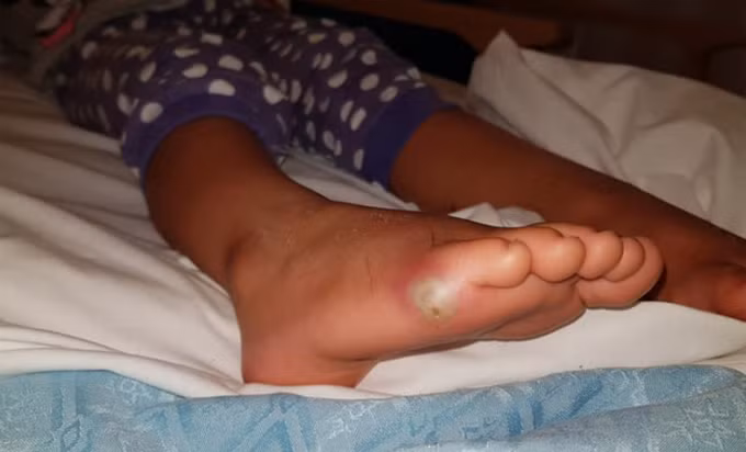 Thomas chia sẻ bức ảnh chụp vết nhiễm trùng ở chân con gái cùng bài viết trên mạng xã hội.