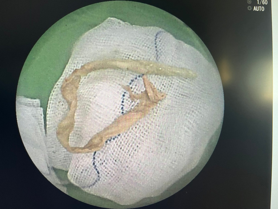 Dị vật là đoạn khăn giấy (được se nhỏ) dài 15cm rơi trong lòng phế quản bệnh nhân. Dị vật là đoạn khăn giấy (được se nhỏ) dài 15cm rơi trong lòng phế quản bệnh nhân.