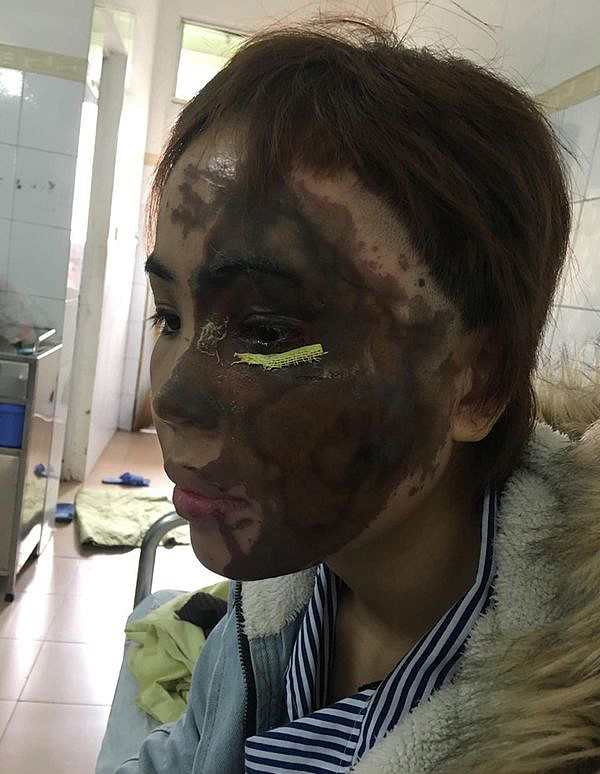 Bác sĩ kể lại hành trình hồi sinh gương mặt xinh đẹp cho cô gái bị thiếu úy tạt axit Bác sĩ kể lại hành trình hồi sinh gương mặt xinh đẹp cho cô gái bị thiếu úy tạt axit