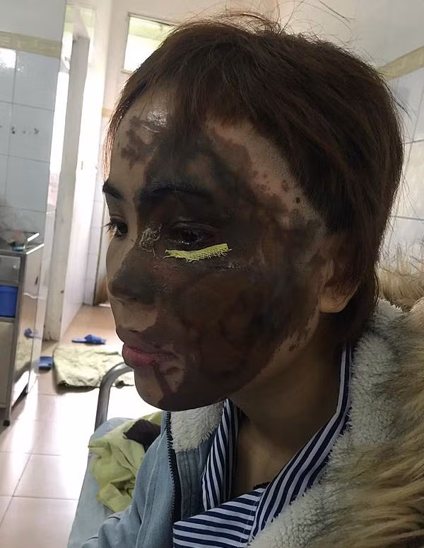 Bác sĩ kể lại hành trình hồi sinh gương mặt xinh đẹp cho cô gái bị thiếu úy tạt axit