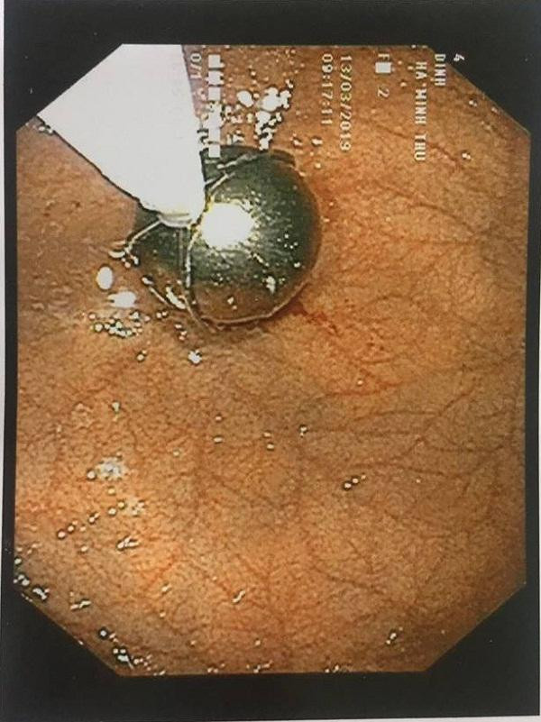 be 21 thang ha noi khoc nac quan nguoi, suyt chet vi ba khoang tay vao mieng moc di vat - 4