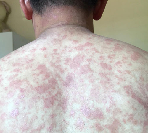 Chưa khỏi bệnh thoát vị đĩa đệm, anh Tùng lại phải chữa viêm da. Ảnh: PN.