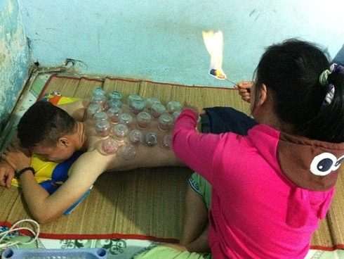 Giác hơi cắt lễ hút "máu độc" coi chừng nhiễm HIV