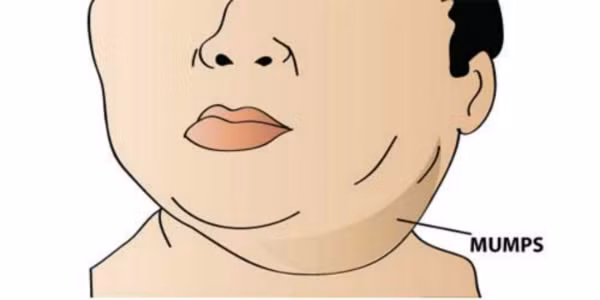 Triệu chứng phổ biến của bệnh quai bị là đau sưng tuyến nước bọt mang tai. Khoảng 30-40% trường hợp đau sưng tuyến nước bọt mang tai. Ảnh: syskool