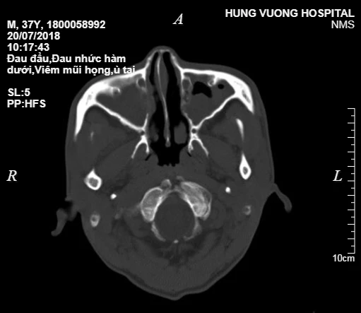 Có thể bị mù mắt, viêm não… vì biến chứng của xoang