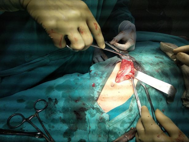 Các bác sĩ phẫu thuật gỡ bỏ các vật thể từ bụng anh Thakur. Hàng chục vật thể sắc nhọn trong bụng người đàn ông