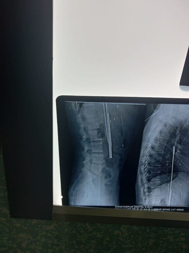 Một phim chụp X-quang cho thấy các vật thể găm trong bụng anh Thakur. Hàng chục vật thể sắc nhọn trong bụng người đàn ông