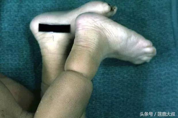 Tưởng chân cháu dính bẩn, bà nội ra sức rửa, ai ngờ suýt chút nữa bác sĩ phải cắt bỏ