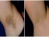 3 công thức 10 phút giúp tẩy sạch lông nách không lo mọc lại