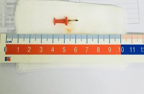 Chơi với em, bé gái 12 tuổi suýt chết vì nuốt phải đinh ghim - Ảnh 1. Chơi với em, bé gái 12 tuổi suýt chết vì nuốt phải đinh ghim - Ảnh 1.