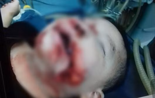  Hình ảnh cháu Đ bị chó tấn công vùng mặt. Ảnh: T.L 