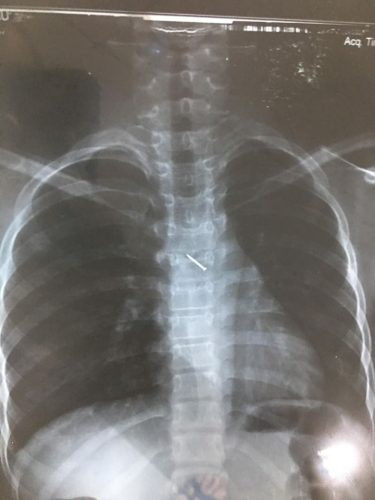 Chơi với em, bé gái 12 tuổi suýt chết vì nuốt phải đinh ghim - Ảnh 2. Chơi với em, bé gái 12 tuổi suýt chết vì nuốt phải đinh ghim - Ảnh 2.