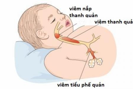 Trời lạnh, đề phòng trẻ viêm tiểu phế quản