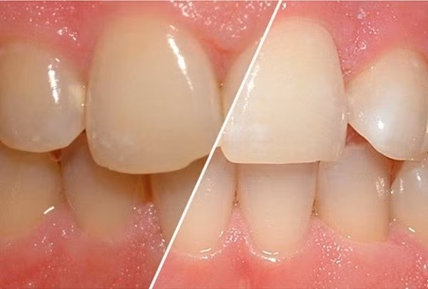 Các cách loại bỏ cao răng hiệu quả mà bạn nên biết