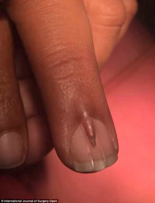 Phát hiện điều “kỳ quái” trên móng tay, người đàn ông mất 4 tháng ròng rã mới tìm được lời giải thích - Hình 2