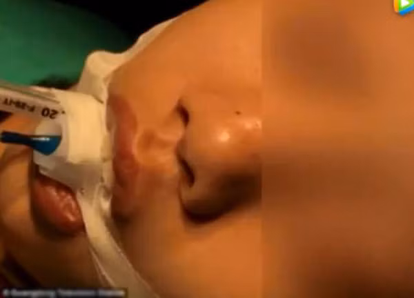 Bé gái bị nhiễm tụ cầu vàng kháng methicillin (MRSA) do nặn mụn tại vùng tam giác nguy hiểm.