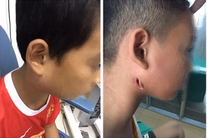 3 bệnh nhi nhiễm bệnh Whitmore. (Ảnh: BVCC).