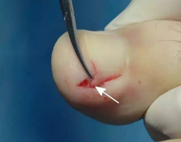 cắt móng tay đến đâu là hợp lý, lưu ý khi cắt móng tay, cắt móng tay đúng cách