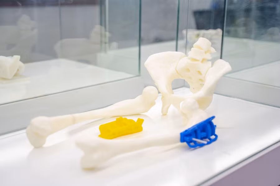 Hình ảnh minh họa trợ cụ dẫn đường phẫu thuật được nghiên cứu và phát triển độc quyền tại Trung tâm Công nghệ 3D trong Y học VinUni, được ứng dụng thành công để phẫu thuật một ca bệnh biến dạng nặng xương đùi.