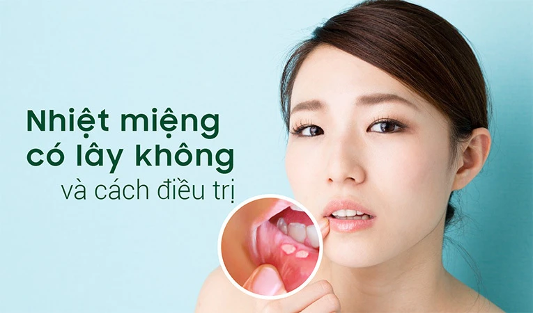 Nhiệt miệng gây xót, đau đớn, khó ăn và khó nói.