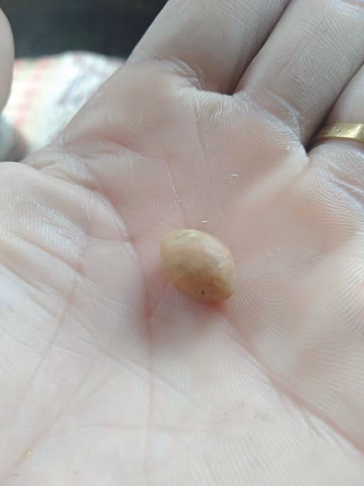 Tưởng dịch nhầy, mẹ Hà Nội giật nảy người khi thấy thứ chui ra từ mũi bé ảnh 5