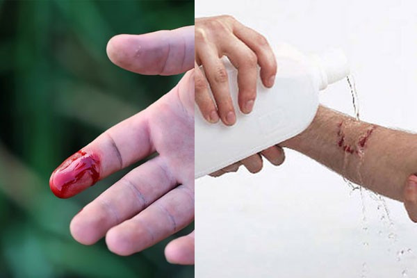 Nếu không may bị đứt tay thì đây chính xác là những gì bạn phải làm - Ảnh 1.