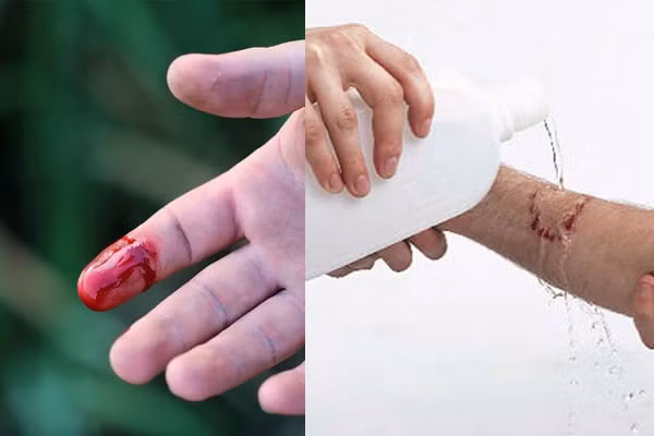 Nếu không may bị đứt tay thì đây chính xác là những gì bạn phải làm - Ảnh 1.