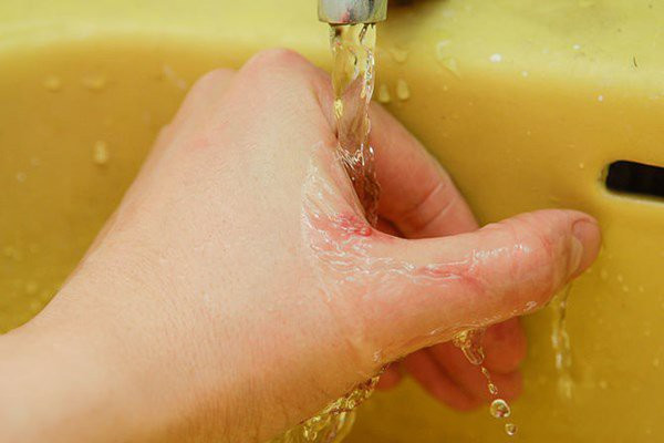 Nếu không may bị đứt tay thì đây chính xác là những gì bạn phải làm - Ảnh 3.