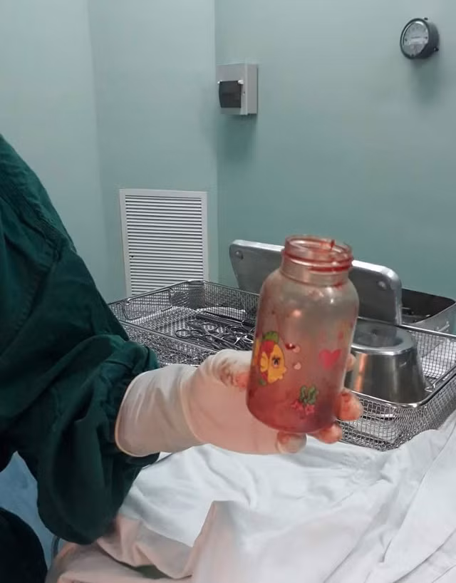 Bình sữa được các bác sĩ lấy ra từ hậu môn của bệnh nhân