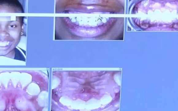 niềng răng, tai nạn niềng răng, tai nạn niềng răng đáng sợ trên thế giới 