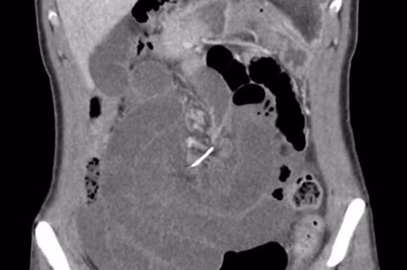 niềng răng, tai nạn niềng răng, tai nạn niềng răng đáng sợ trên thế giới 