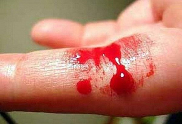 Bệnh Hemophilia benh Hemophilia