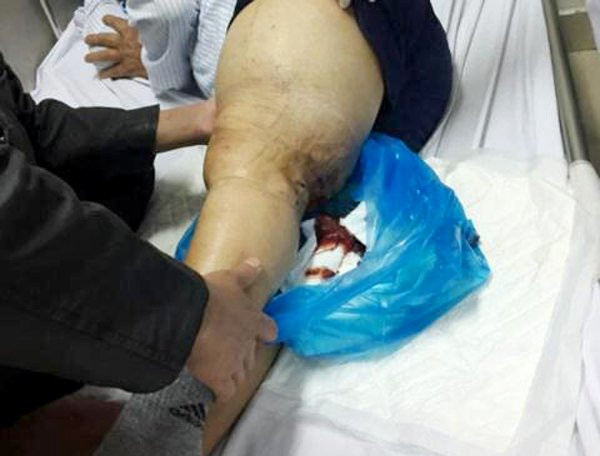 Bệnh máu khó đông benh mau kho dong