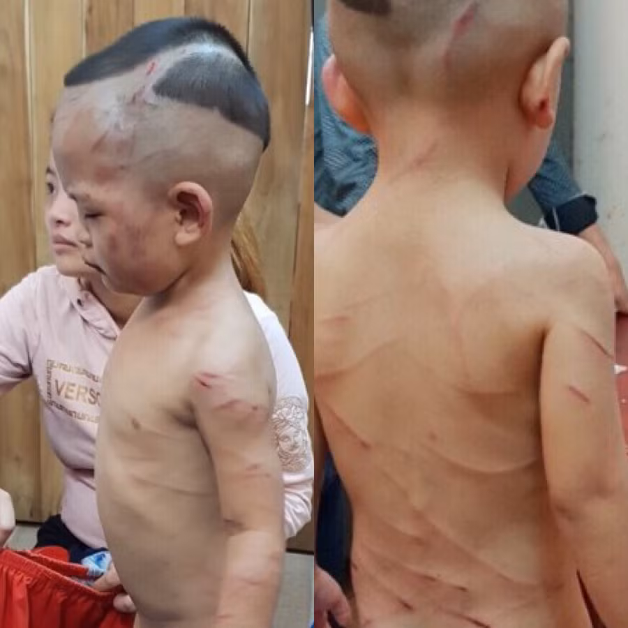 Kiên Giang: Khởi tố cha dượng đánh đập dã man bé trai 3 tuổi thương tích khắp cơ thể