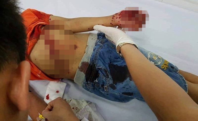 {title} Pin đồ chơi phát nổ, bé trai nhoe nhoét vết thương