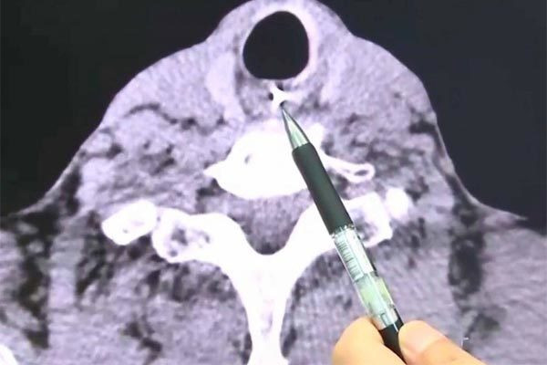 Ăn cháo nuốt phải răng giả, cụ ông nguy kịch ảnh 1 Nhập viện cấp cứu vì nuốt phải răng giả trong khi ăn cháo