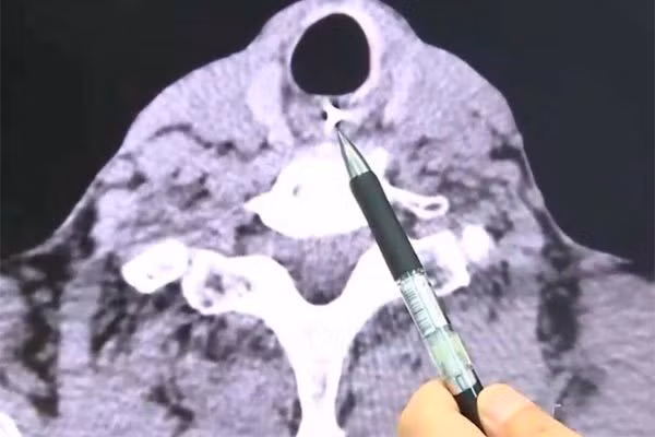 Nhập viện cấp cứu vì nuốt phải răng giả trong khi ăn cháo