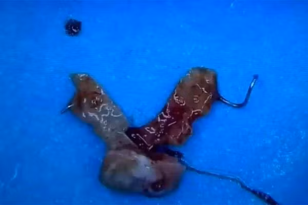 Nhập viện cấp cứu vì nuốt phải răng giả trong khi ăn cháo