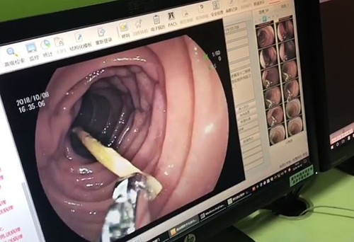Hình ảnh nội soi cho thấy chiếc đũa gỗ nằm trong ruột của bà Ye. Ảnh: Pear